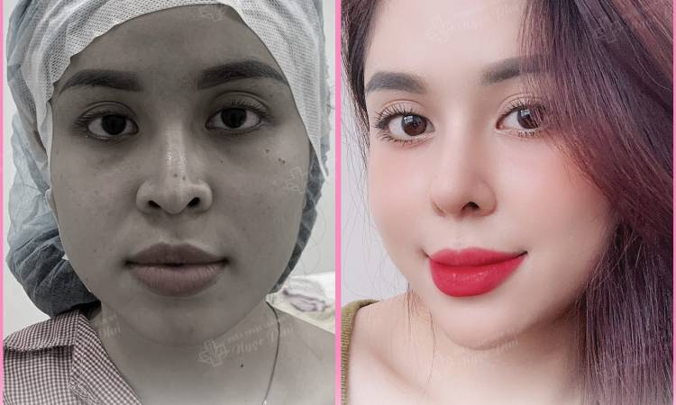 muốn biết nâng mũi giữ được bao lâu? Kết quả có vĩnh viễn không? - Câu trả lời sẽ phụ thuộc vào kỹ thuật bác sĩ và cơ địa của cá nhân. 