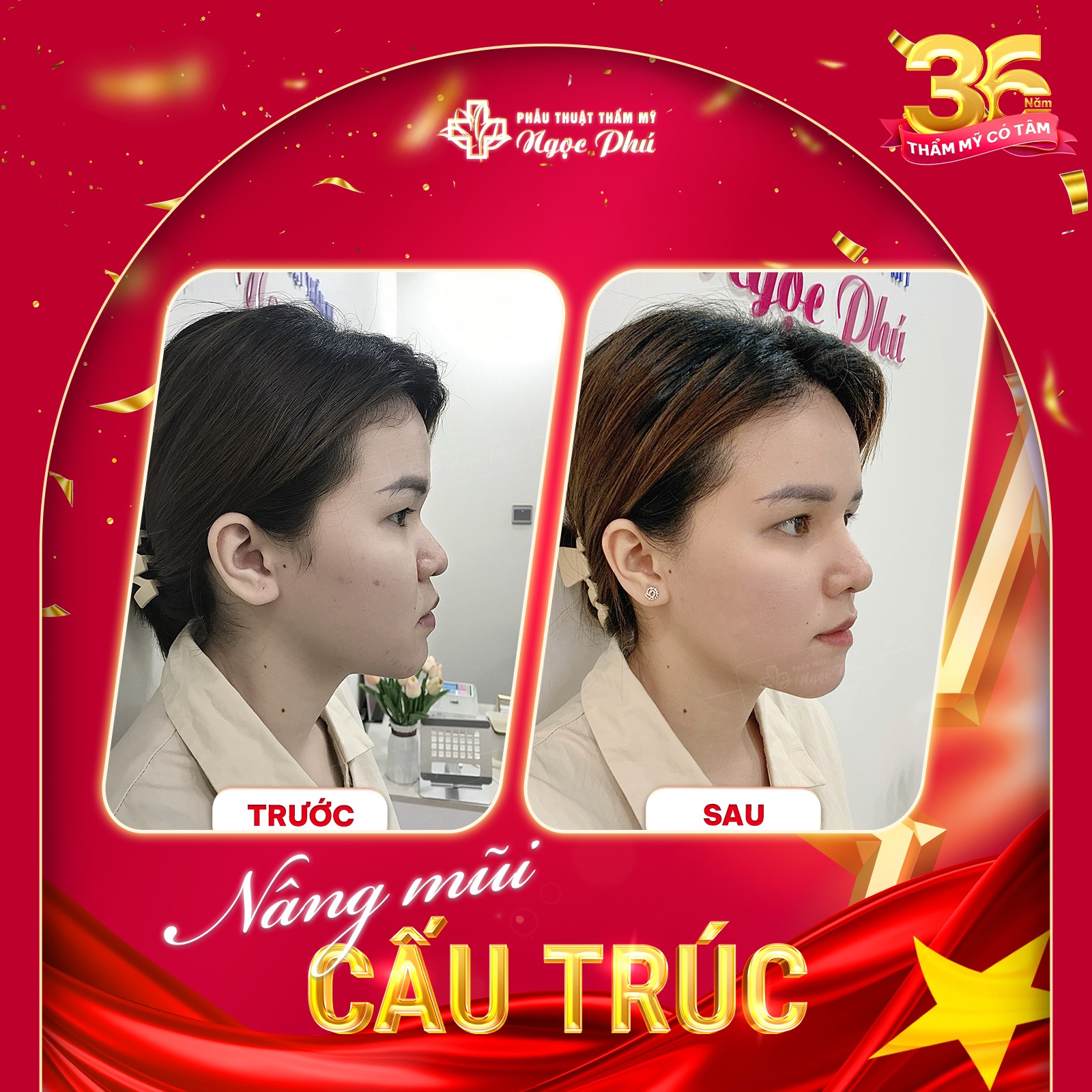 Phương pháp nâng mũi cấu trúc sẽ có thể được nhiều người yêu thích và lựa chọn. 