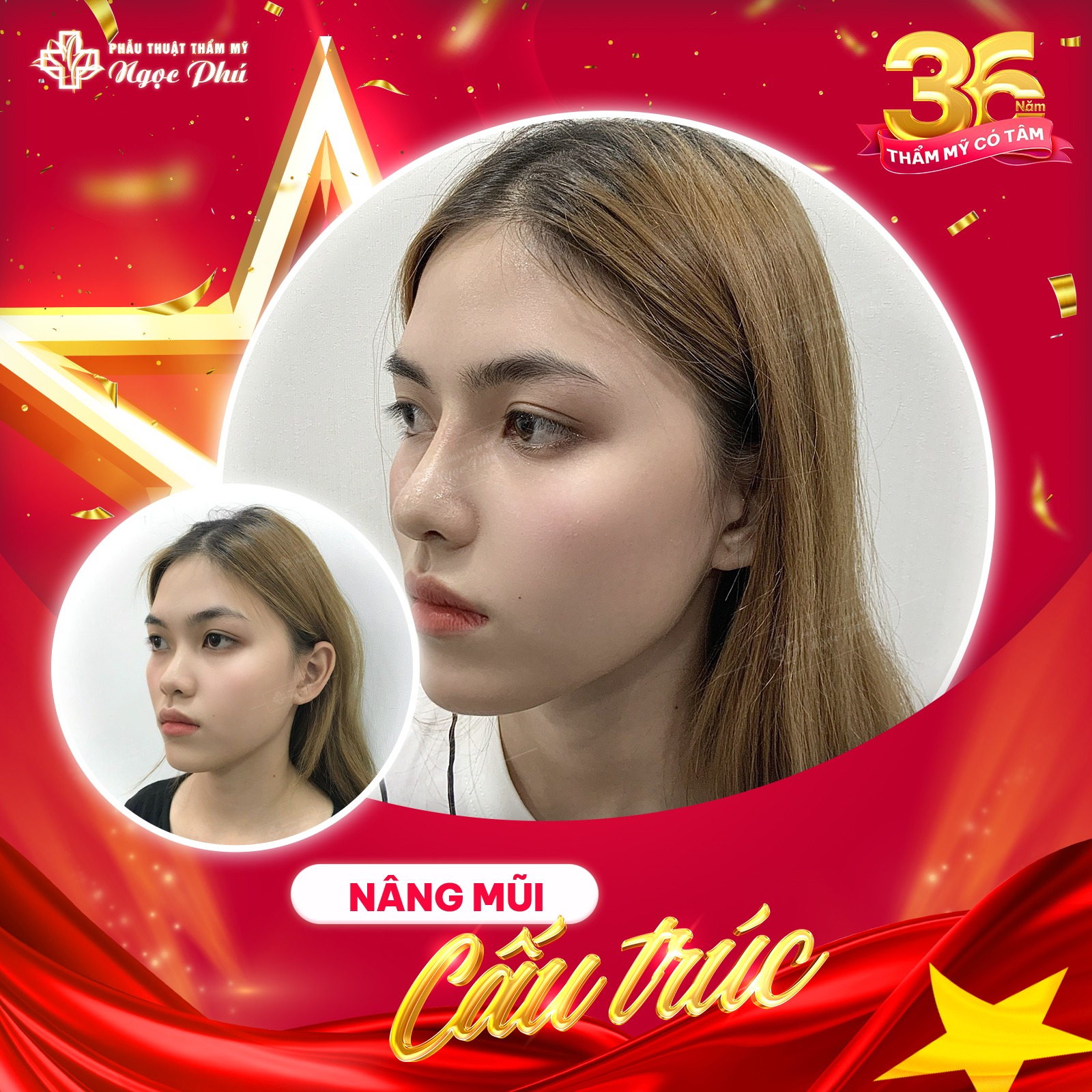 Nâng mũi Hàn Quốc là một phương pháp thẩm mỹ mũi bắt nguồn từ xứ sở Kim chi