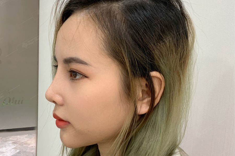 Nâng mũi thường là trong quá trình thực hiện, bác sĩ chỉ sử dụng sụn nhân tạo để tạo độ cao cho toàn bộ sống mũi, tạo sự cân đối với khuôn mặt mà không can thiệp vào cấu trúc tự nhiên của mũi.