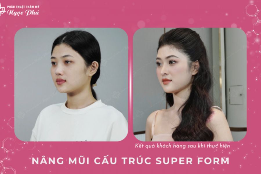 Nâng mũi cấu trúc là một quá trình có sự can thiệp phẫu thuật sâu vào cấu trúc mũi vô cùng phức tạp, từ việc điều chỉnh sống mũi đến đầu mũi nhằm khắc phục mọi khuyết điểm, thông qua việc kết hợp thông minh giữa sụn nhân tạo và sụn tự thân.