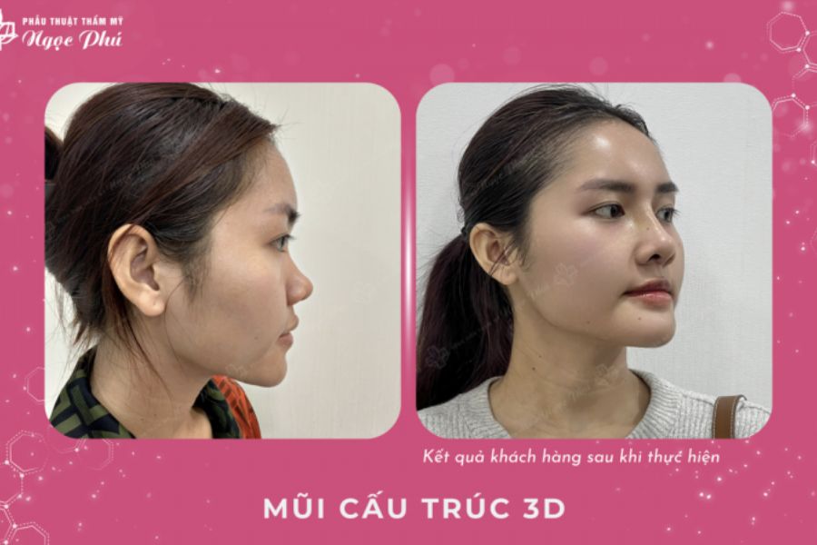 Lựa chọn giữa nâng mũi thường và nâng mũi cấu trúc phụ thuộc vào nhu cầu và điều kiện cụ thể của mỗi người.