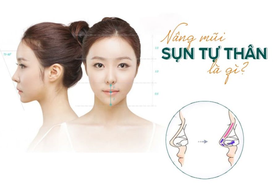 Trong lĩnh vực thẩm mỹ, một trong những giải pháp được ưa chuộng nhất hiện nay là nâng mũi tự thân, được nhiều người quan tâm.