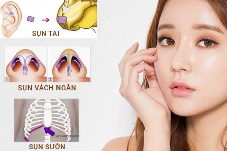 Nâng mũi tự thân là phương pháp dùng chính sụn từ trong cơ thể của bạn để thực hiện phẫu thuật nâng mũi, sụn tự thân sẽ được lấy từ: Sụn vành tai, sụn sườn.