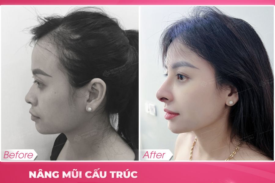 Sụn tự thân có độ tương thích cao với cơ thể, giảm thiểu nguy cơ dị ứng và hạn chế xảy ra hiện tượng đào thải sụn.