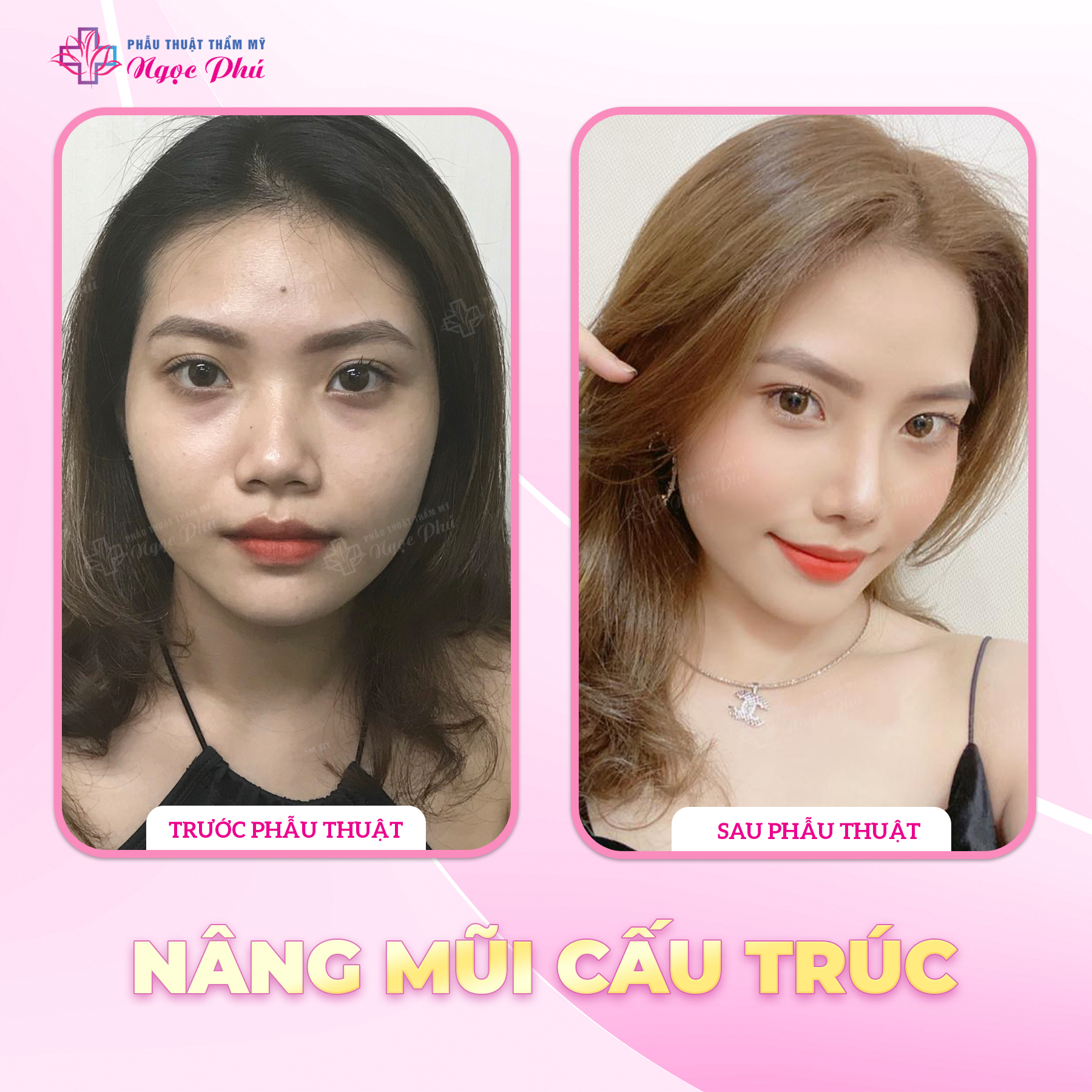 Khi nghĩ đến nâng mũi, có một số người sẽ có chung một câu hỏi “liệu nâng mũi vĩnh viễn được không?”. 