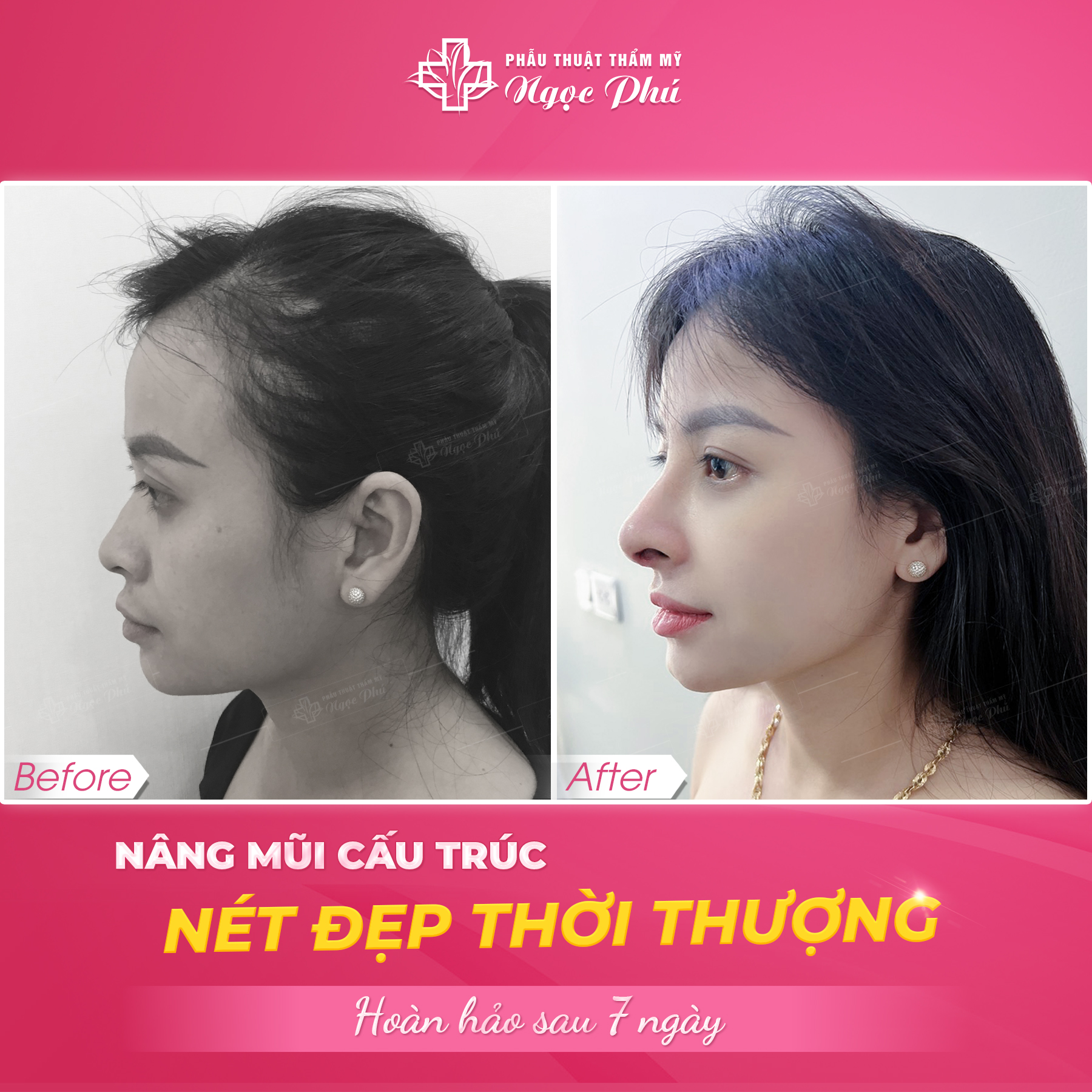 Bạn biết không nâng mũi vĩnh viễn hay không sẽ phụ thuộc rất lớn vào tay nghề của bác sĩ thực hiện độn mũi cho chính bạn.
