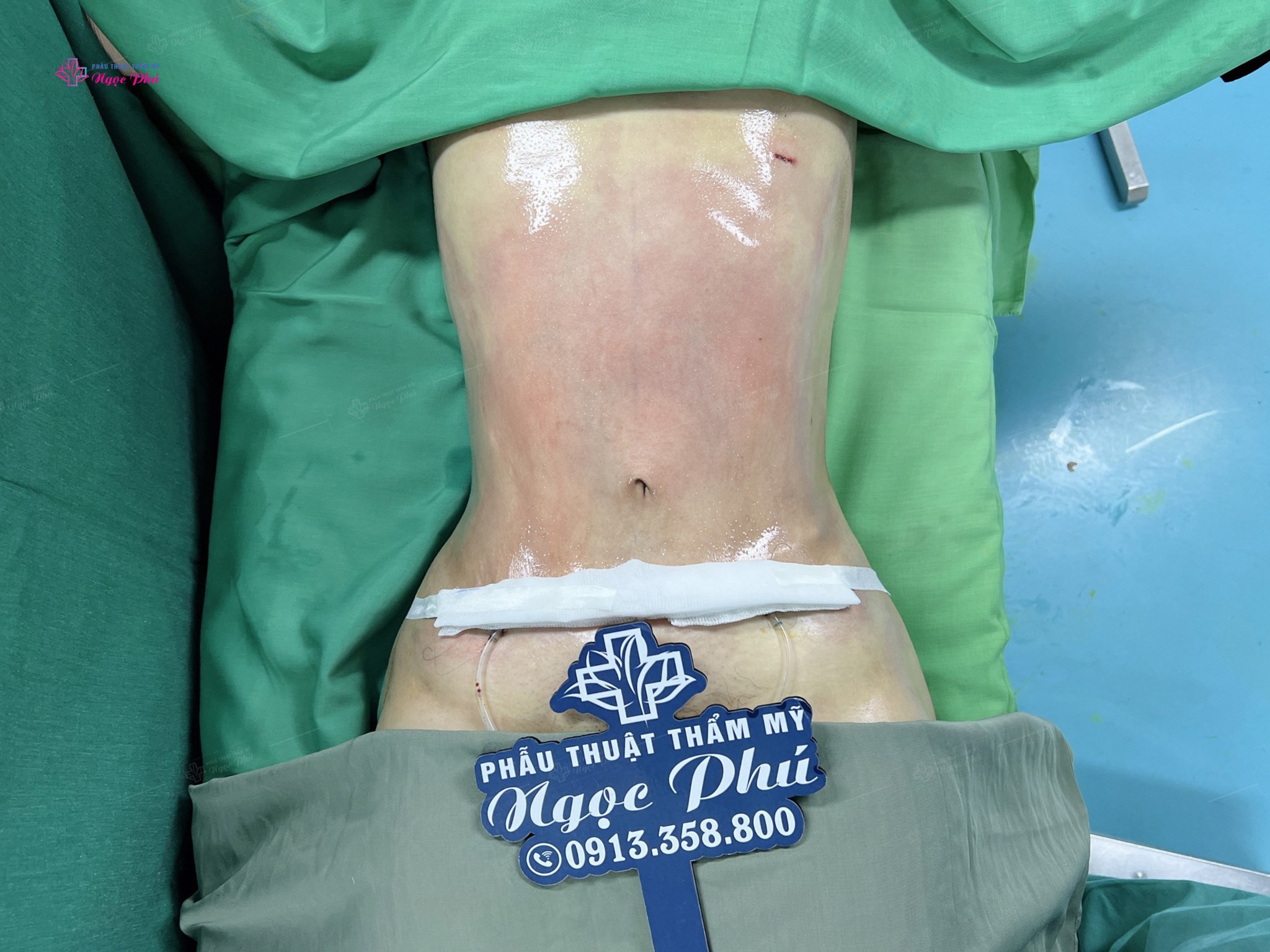 Phẫu thuật hút mỡ bụng có thể mang lại kết quả dài hạn nhưng không phải là kết quả vĩnh viễn.