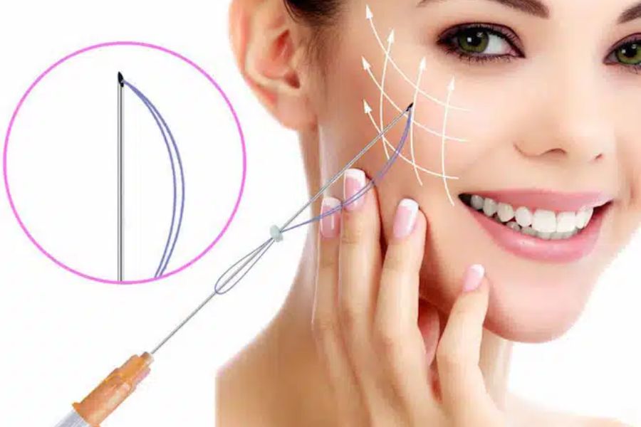 quy trình căng chỉ da mặt