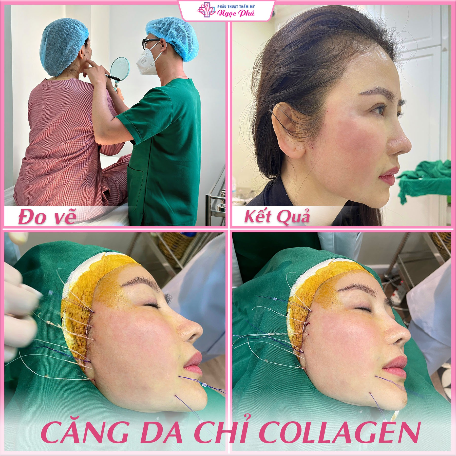 Trả lại gương mặt tươi trẻ sau khi thực hiện quy trình căng chỉ da mặt tại Ngọc Phú