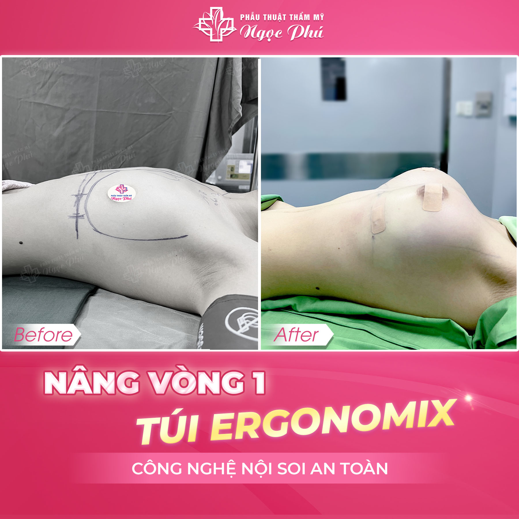 Tại Thẩm mỹ Ngọc Phú, chúng tôi cam kết mang đến dịch vụ nâng ngực an toàn không ảnh hưởng đến thiên chức làm mẹ của người phụ nữ. 