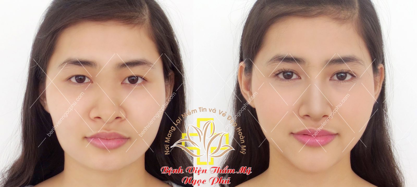 Thẩm mỹ chuẩn Hàn với Giáo sư - Bác Sĩ Lee Jung Hoon-5