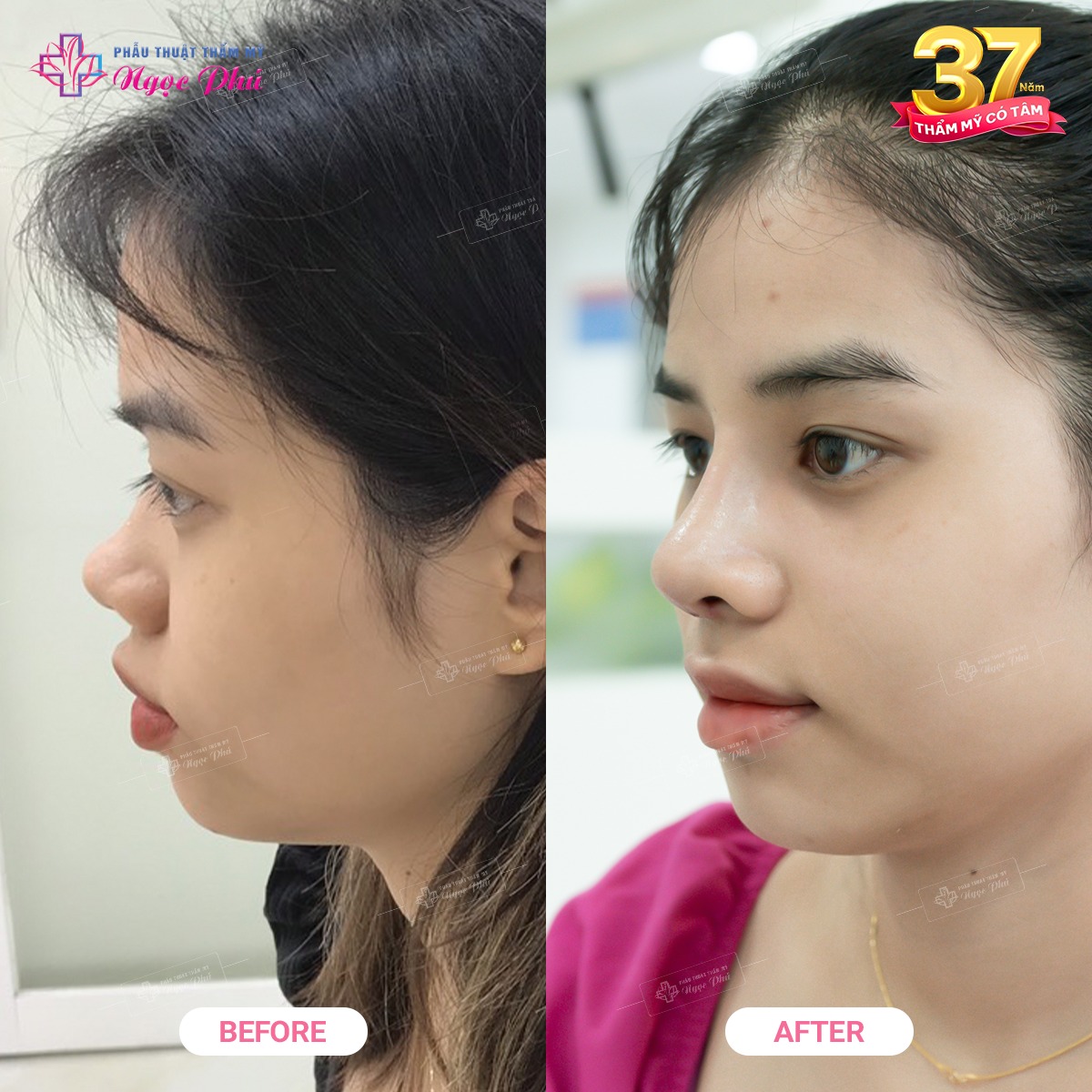 Nâng mũi s-line Hàn Quốc trước và sau khi thực hiện