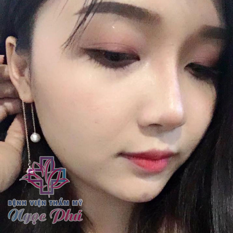 Khách hàng nâng mũi bọc sụn 1